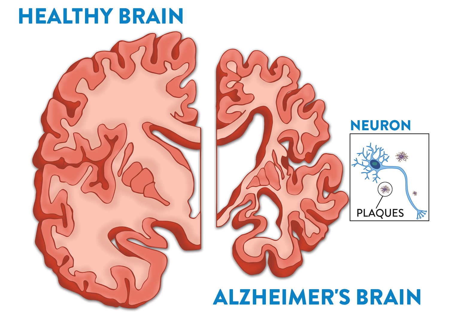 Brain | Fisher Center For Alzheimer's Research Foundation